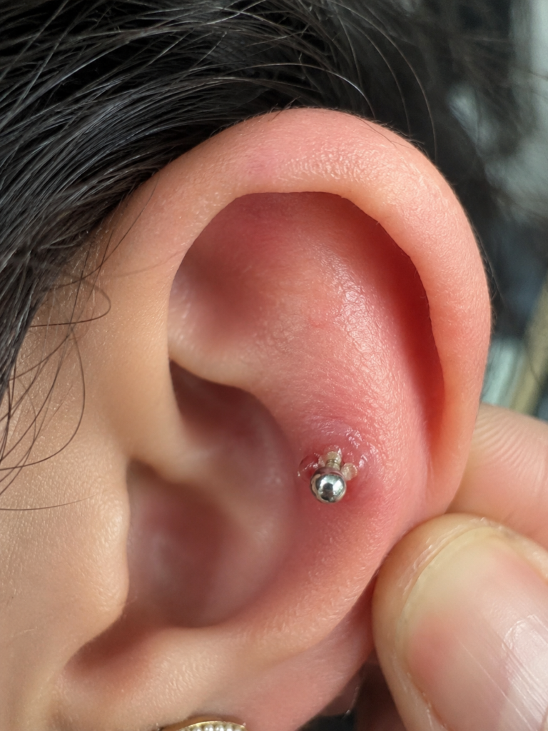Helix piercing irritation with a piercing bump before professional piercing recovery treatment.